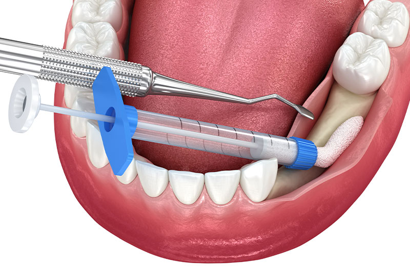 Bone Grafting in Litchfield Park