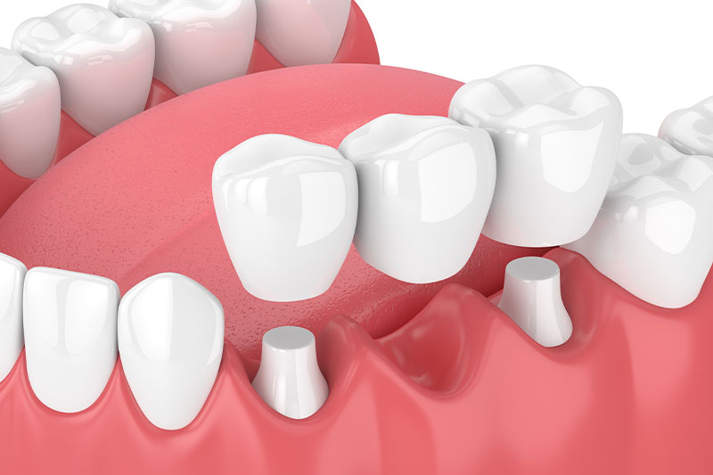 Dental Bridges in Litchfield Park