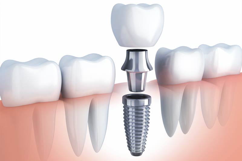 Implants Dentist in Litchfield Park