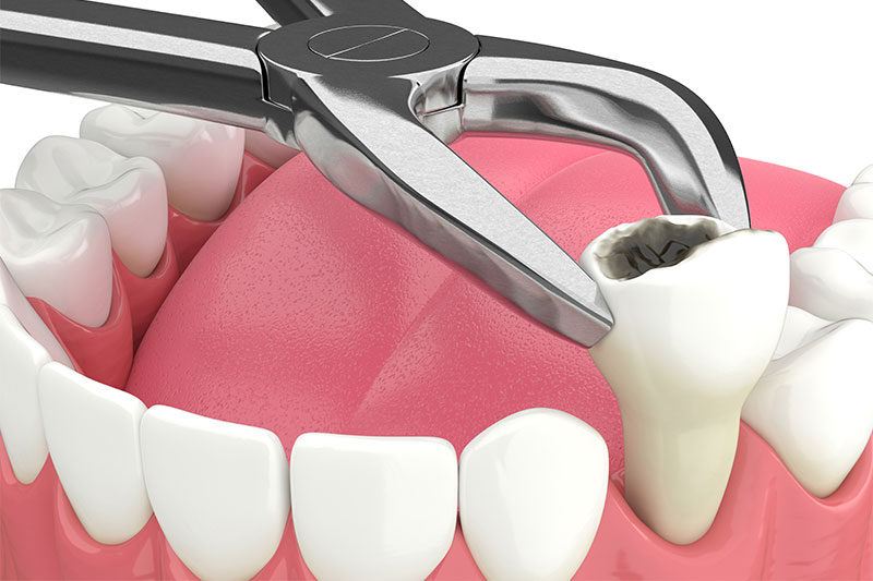 Tooth Extraction in Litchfield Park