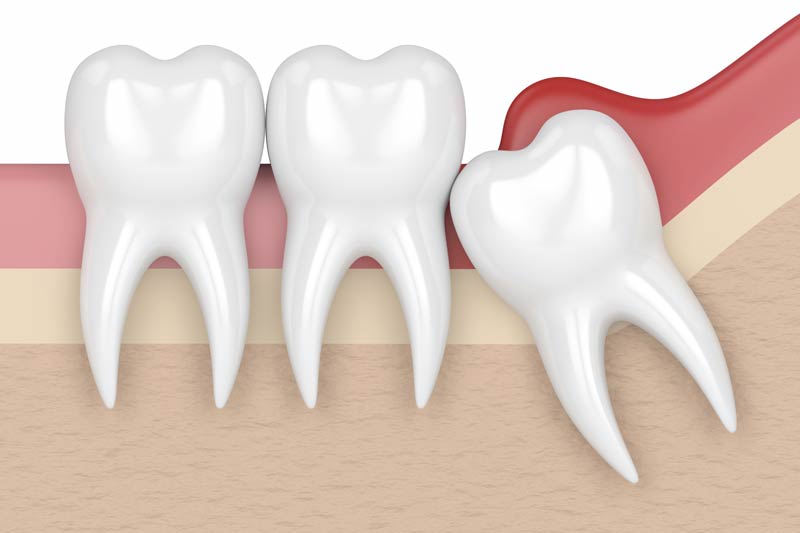 Wisdom Tooth Removal in Litchfield Park