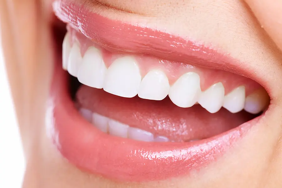 Types of Dental Veneers