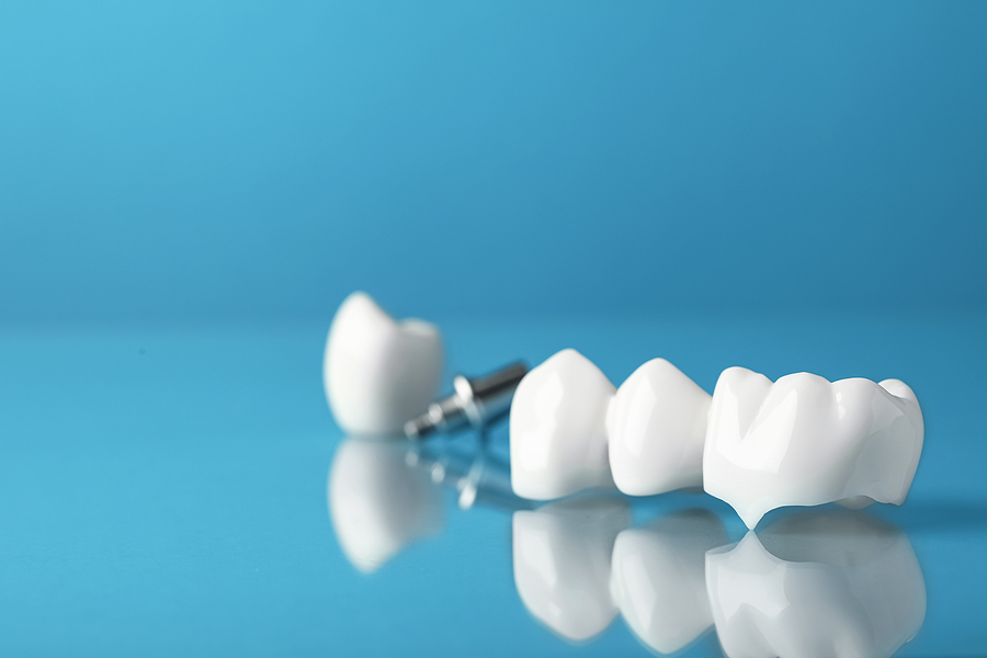 Types of Dental Crowns