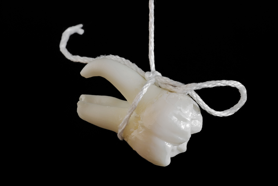 Unveiling the Benefits of Dental Extractions