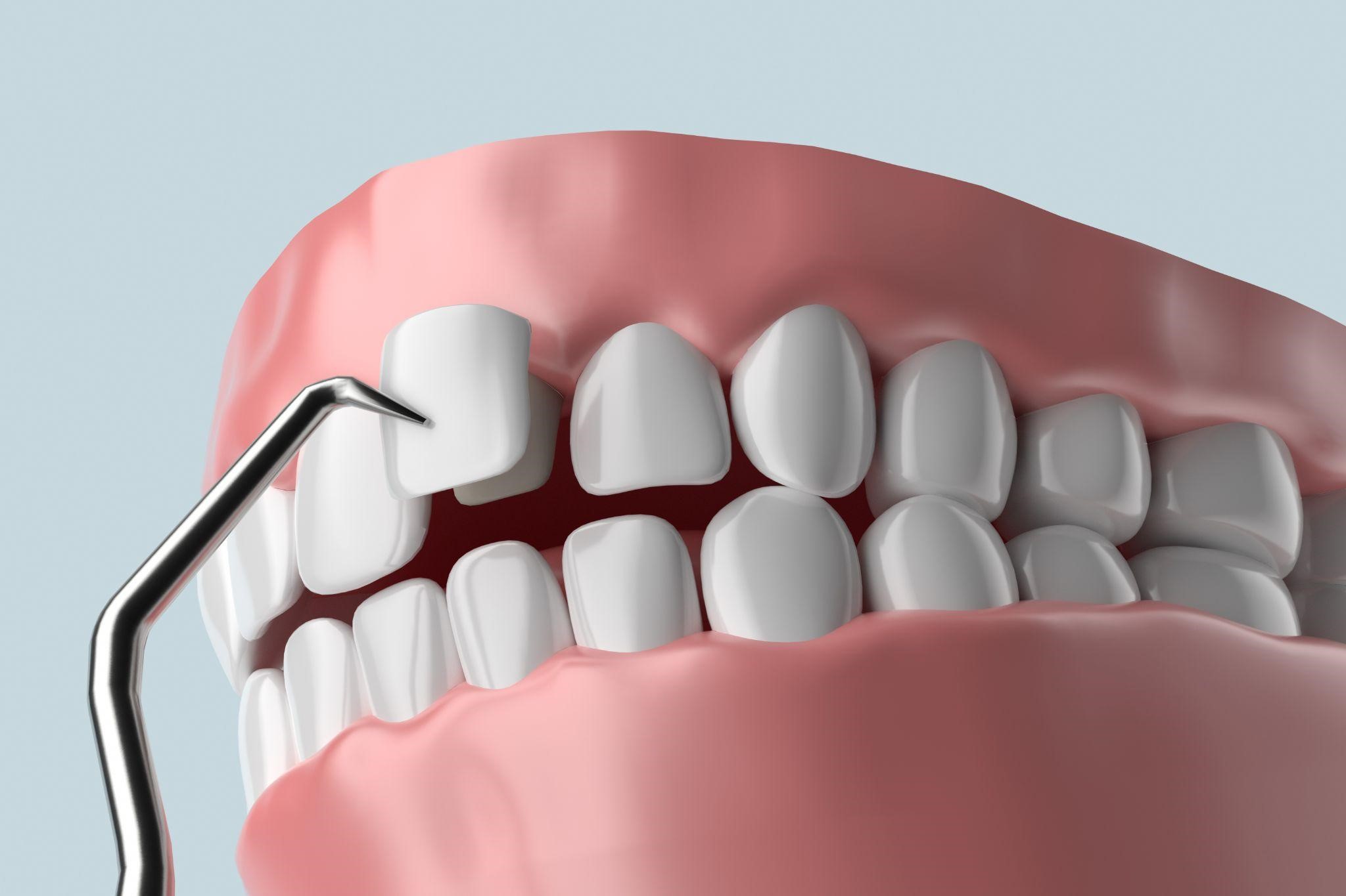 Types of Dental Veneers