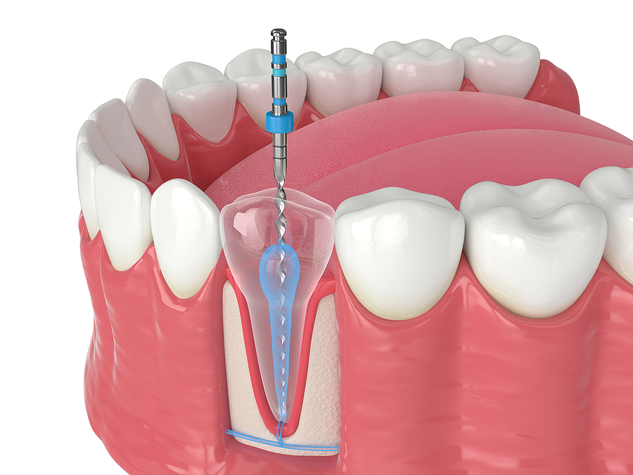 Preserving Your Smile with Expert Endodontics in Litchfield Park, AZ