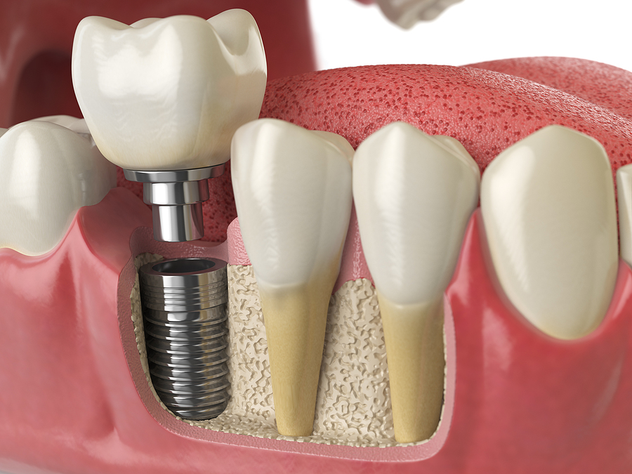 The Ultimate Guide to Implants in Litchfield Park, FL: Benefits, Procedure, and Aftercare